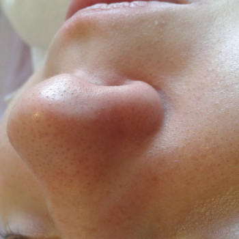 Носик до чистки