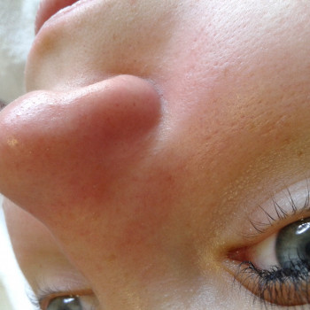 Носик после чистки