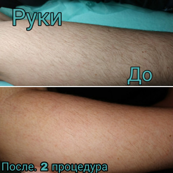 Электроэпиляция. Руки до локтя. До процедуры и после 2 - х п
