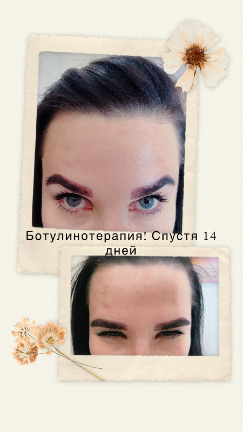 Эффект ботулинотерапии, фото -  