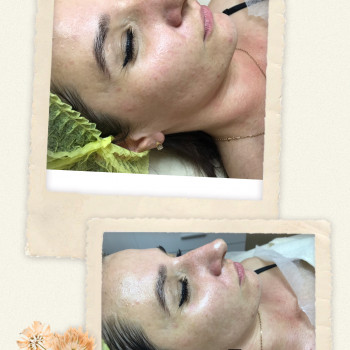 Голівудське сяйво до/після