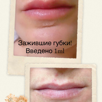 Контурна пластика губ