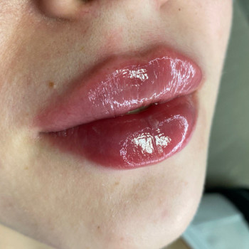 Збільшення губ
                    Косметолог Евгения Кривий Ріг