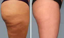 Антицелюлітний вакуумний масаж. Моделювання фігури VelaShape Массажист Татьяна Чернигов