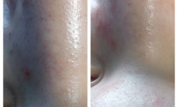 Ультразвукове очищення шкіри Косметолог Юлия Черкассы