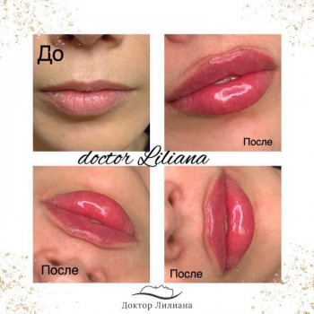 Фото "до" и сразу " после" процедуры