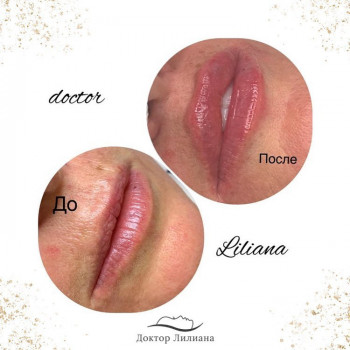 Фото "до" и сразу " после" процедуры