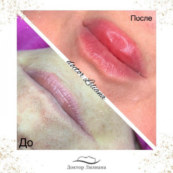 Фото "до" и сразу " после" процедуры