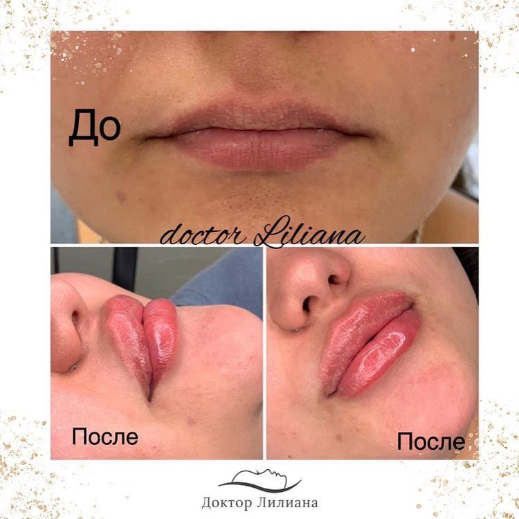 Фото "до" и сразу " после" процедуры, фото - Медицинские услуги Доктор Лилиана