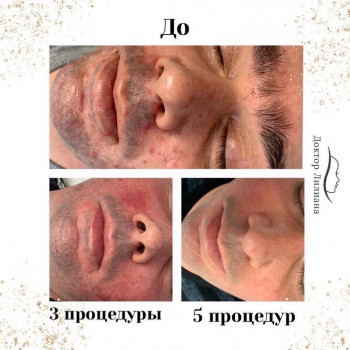 Лечение проблемной кожи
                    Медицинский центр Доктор Лилиана Одесса