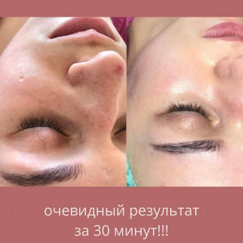 сравнительное фото процедуры фарфоровая кукла