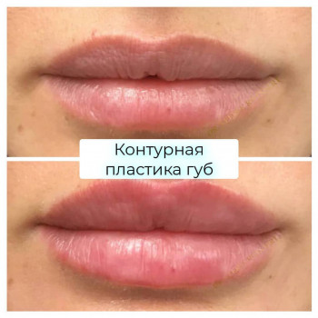 увеличение губ
