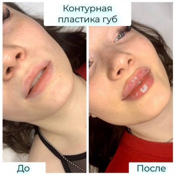 увеличение губ, уколы ботокса для лица