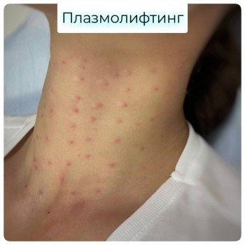 уколи ботокса для обличчя, корекціяз моршок, уколи в обличчя