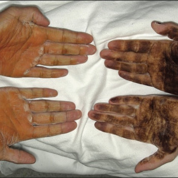 Лечение гипергидроза (подмышечных ямок, ладоней, подошв)
                    Пластический хирург Александр Херсон