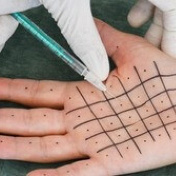 Лечение гипергидроза (подмышечных ямок, ладоней, подошв)
                    Пластический хирург Александр Херсон