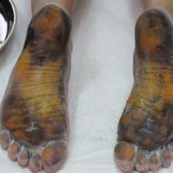 Лечение гипергидроза (подмышечных ямок, ладоней, подошв)
                    Пластический хирург Александр Херсон