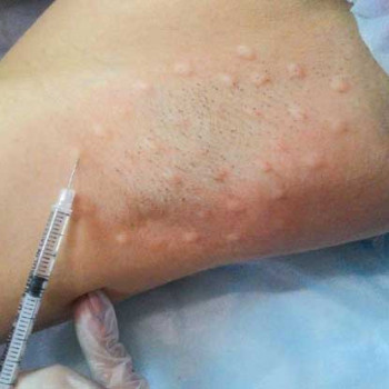 Лечение гипергидроза (подмышечных ямок, ладоней, подошв)
                    Пластический хирург Александр Херсон