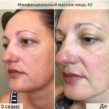 Буккальный & Миофасциальный массаж лица, шеи и головы
                    Косметолог Жанна Київ