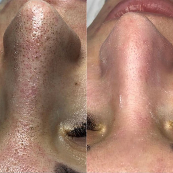 Если Вас беспокоит угревая болезнь, открытые и закрытые коме