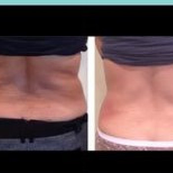 Антицелюлітний масаж, кавітація