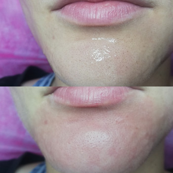 Чистка лица + пилинг
                    Дерматолог косметолог Ая Суми