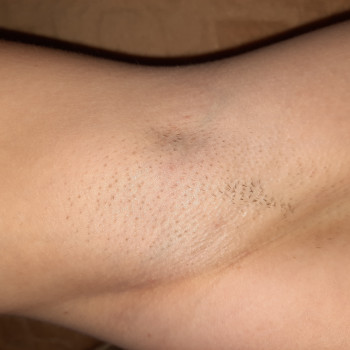 Лазерная эпиляция
                    Мастер депиляции Татьяна Анатольевна Каменское