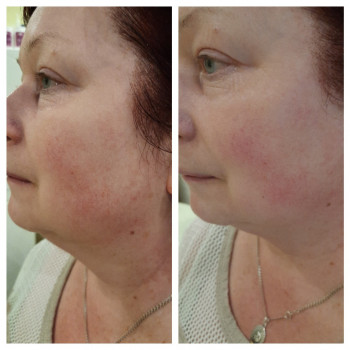   
До и через 10 дн