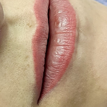 Зажившие губы перед коррекцией