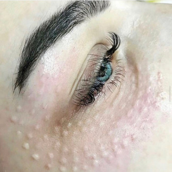 Біорепарація обличчя шиї декольте
                    Лікар-косметолог Юлия Харків