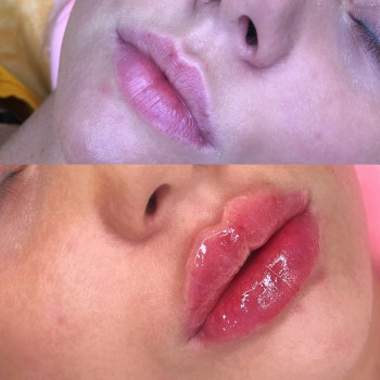 Контурна пластика губ збільшення губ
                    Лікар-косметолог Юлия Харків