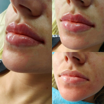 Контурна пластика губ збільшення губ
                    Лікар-косметолог Юлия Харків