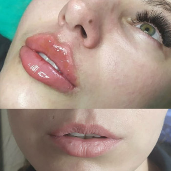 Контурна пластика губ збільшення губ
                    Лікар-косметолог Юлия Харків