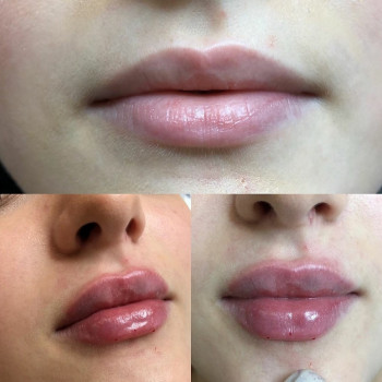 Контурна пластика губ збільшення губ
                    Лікар-косметолог Юлия Харків