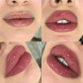 Контурна пластика губ збільшення губ
                    Лікар-косметолог Юлия Харків