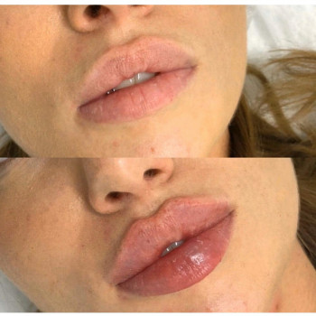 Контурна пластика губ збільшення губ
                    Лікар-косметолог Юлия Харків