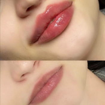 Контурна пластика губ збільшення губ
                    Лікар-косметолог Юлия Харків