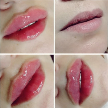 Контурна пластика губ збільшення губ
                    Лікар-косметолог Юлия Харків