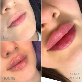 Контурна пластика губ збільшення губ
                    Лікар-косметолог Юлия Харків