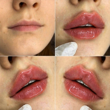 Контурна пластика губ збільшення губ
                    Лікар-косметолог Юлия Харків