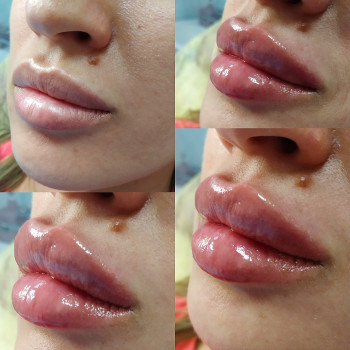 Контурна пластика губ збільшення губ
                    Лікар-косметолог Юлия Харків