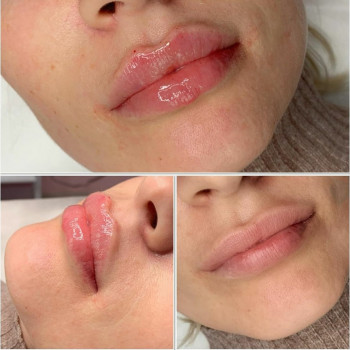 Контурна пластика губ збільшення губ
                    Лікар-косметолог Юлия Харків