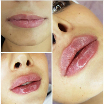 Контурна пластика губ збільшення губ
                    Лікар-косметолог Юлия Харків