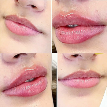 Контурна пластика губ збільшення губ
                    Лікар-косметолог Юлия Харків