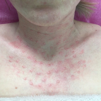 Биоревитализация шеи, декольте