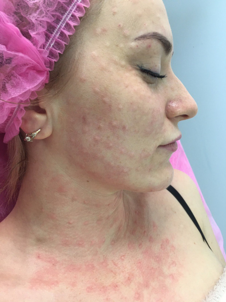 Биоревитализация лица, шеи, декольте, фото - Косметолог Анна Зубок