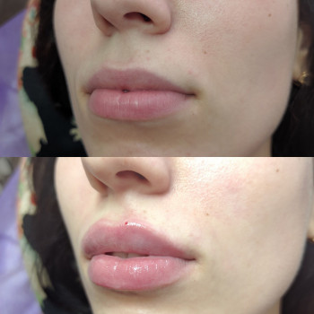 Увеличение объёма губ. Техника бант.