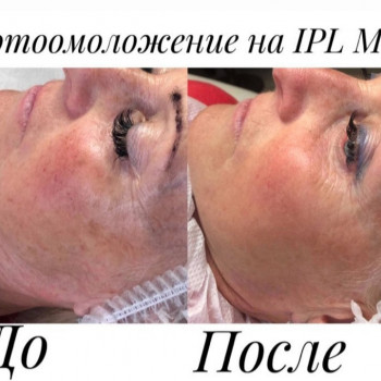 Фотолікування Lumenis M22