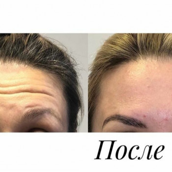 Ботокс лоба