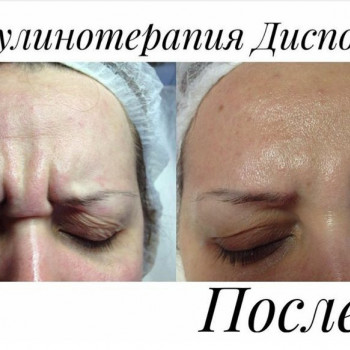Ботулінотерапія
                    Дерматолог косметолог Елена Белая Церковь